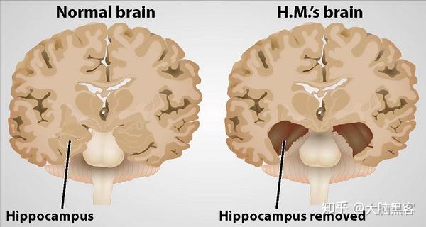 m.被切除海马体后的大脑