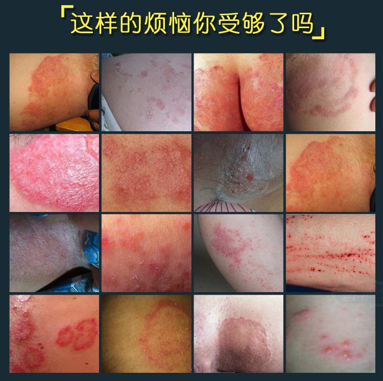 大腿内侧瘙痒是股癣还是湿疹该如何护理呢?