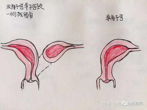 一种是有内膜但不与单角子宫相通,这种在青春期月经来潮时会表现为