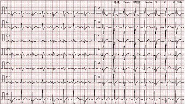 心电图图库丨完全性右束支阻滞系列