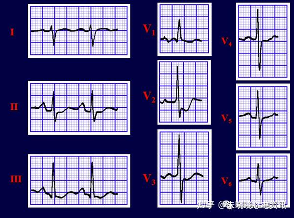 右心室肥大:电压增高,电轴右偏≥ 90°,1,2导联st段压低,t波倒置.