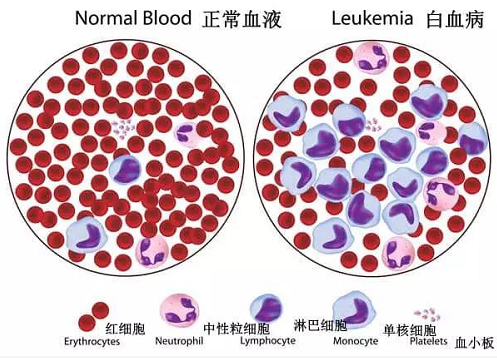 世界白血病日血癌没救出现这些及时就医