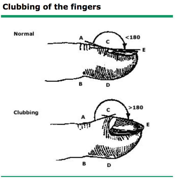 fingers ), 在正常的手指,从a点到b点的垂直距离>c点到d点的垂直距离