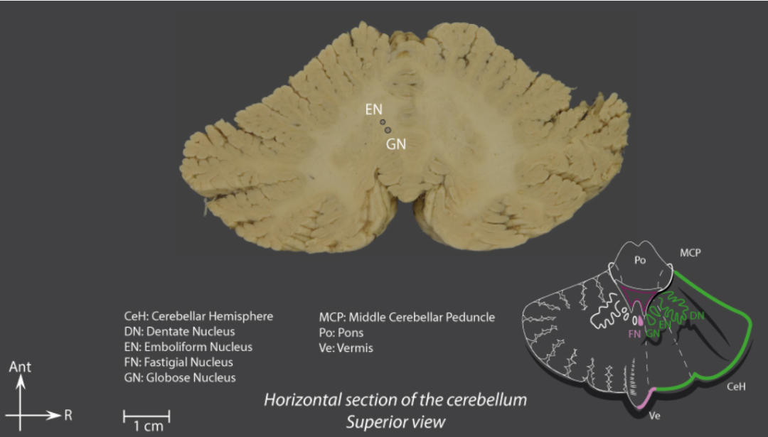 核(fastigial nucleus,球状核(globose nucleus,栓状核(emboliform