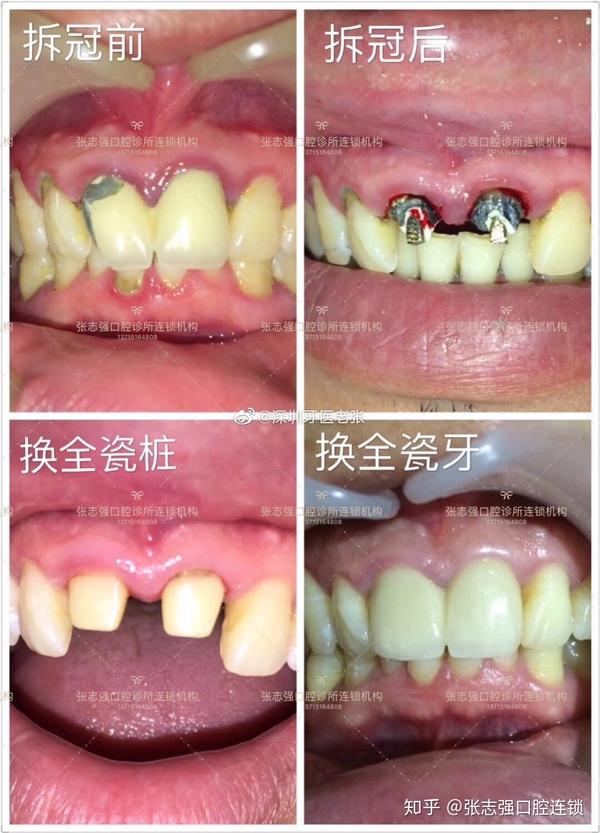 拆除金属烤瓷牙系列一