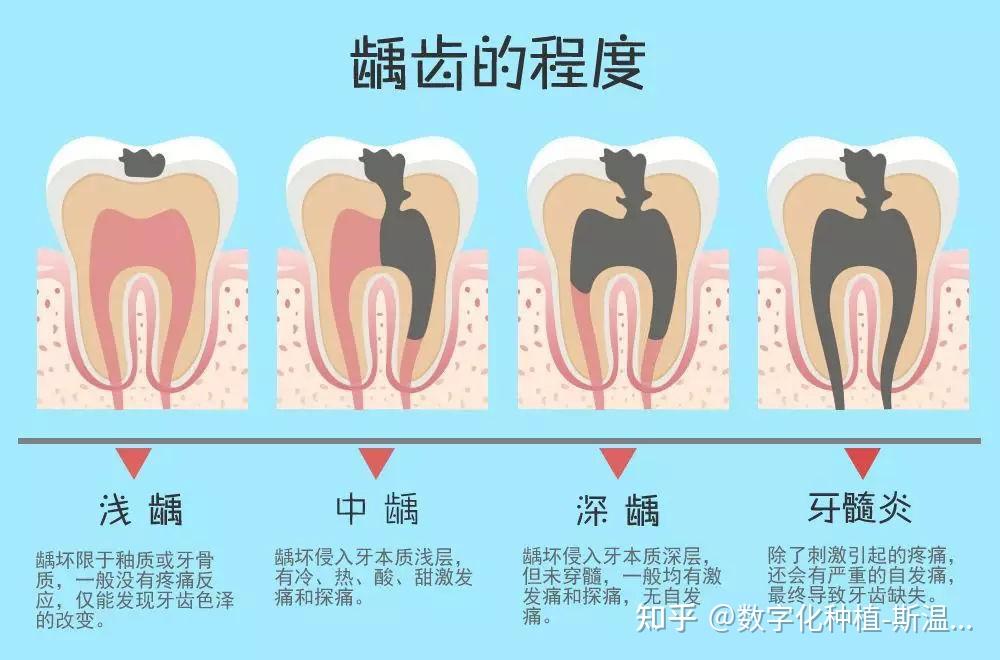 龋齿的形成是一个缓慢的过程,一般需要1到2年的时间,从浅到深分为
