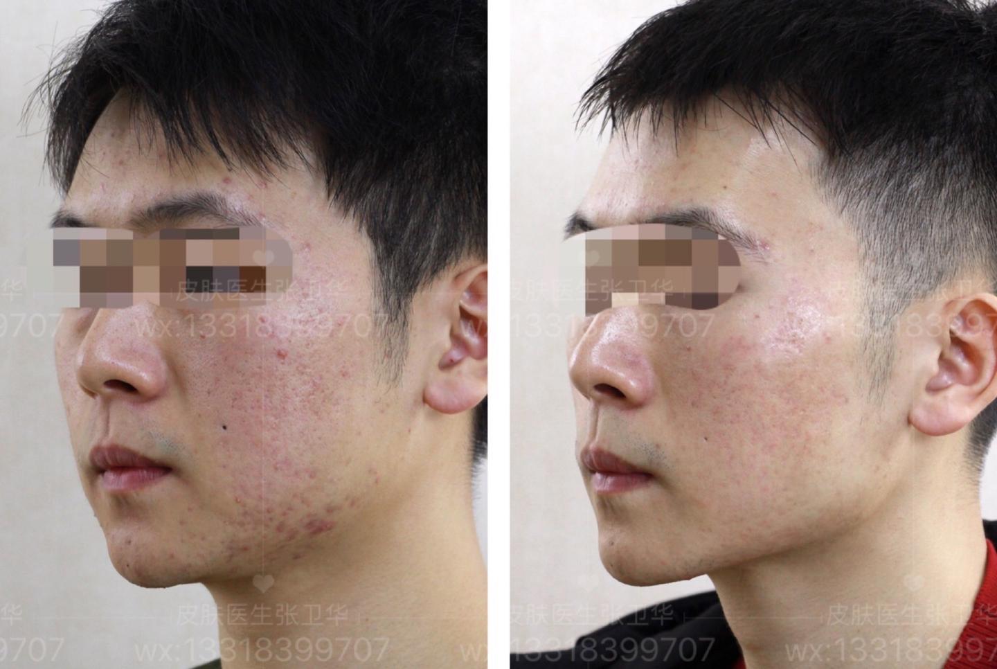 痘痘 痘坑并存的皮肤怎么办?记录治疗过程
