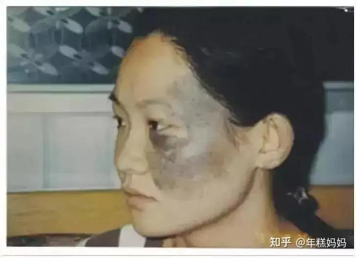 大部分的研究认为,太田痣的形成原因和"蒙古斑"相同,且发生恶变的概率