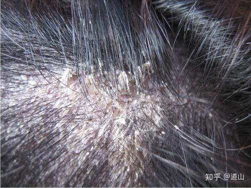 因为从根上就错了,这个头屑是头皮湿疹导致的,要从湿疹入手