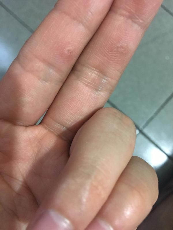 困扰我两年多的趾疣终于好了把我的过程分享给大家希望能帮到你