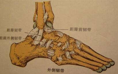 总也好不了的踝扭伤—前距腓韧带损伤