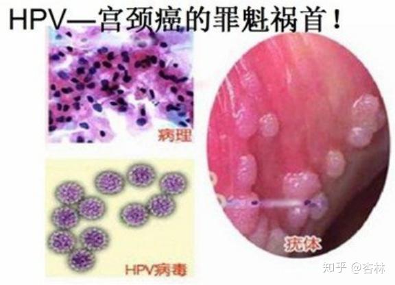人类乳头瘤病毒(hpv)与男性生殖关系