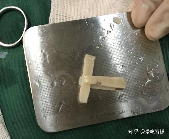 简单的肋软骨隆鼻鼻尖支架示意图