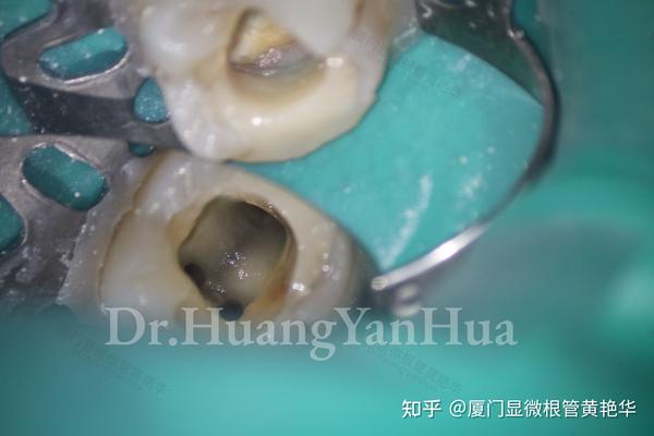 发现了增生的牙髓息肉,经过完善的根管治疗后,这颗牙齿后期嵌体修复