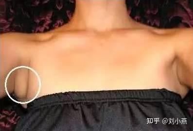 刘燕酿制副乳是乳腺癌淋巴癌的前奏