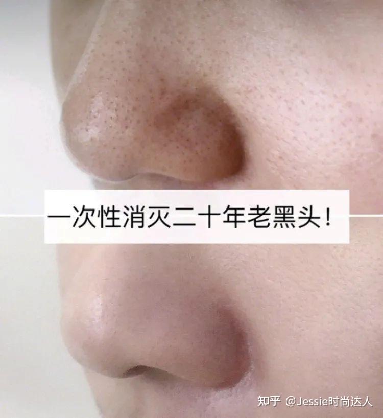 1连根"拔"起白头黑头让尖俏娇小的鼻尖像剥了壳的蛋一样你以前可能也