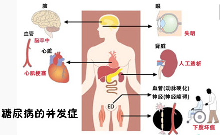 紧急科普糖尿病并发症的前兆及预防