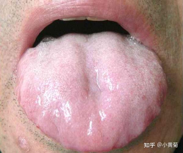 看舌头舌象分析与疾病二