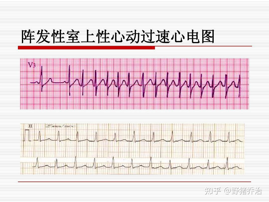 室上性心动过速常见的症状有哪些