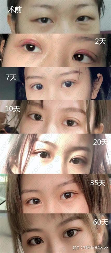 全切去皮去脂加开内外眼角
