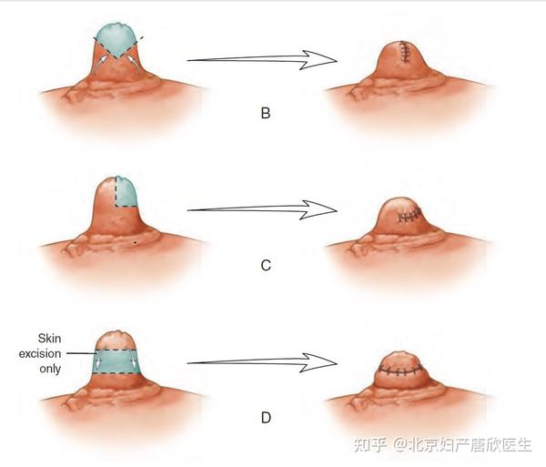 你所不了解的乳头缩小术