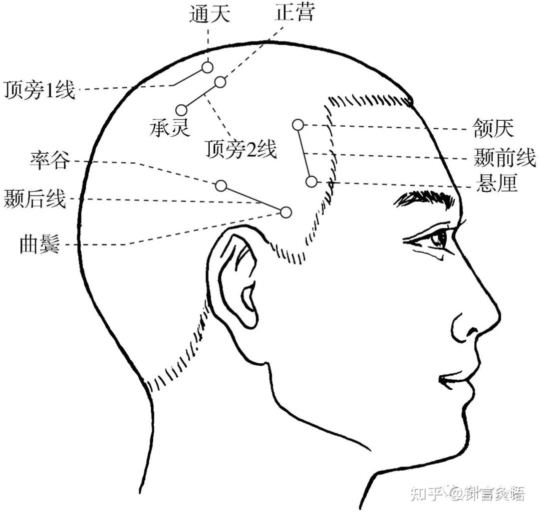 焦顺发头针疗效如何