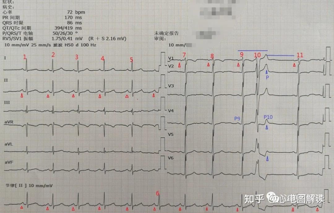 图22,室性早搏.1,窦性心律,心电图诊断:r5由p4下传而来,pr间期约0.