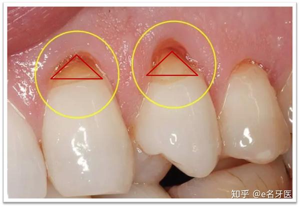 楔状缺损 楔状缺损是指牙颈部釉质及牙骨质交界处硬组织发生缓慢消耗