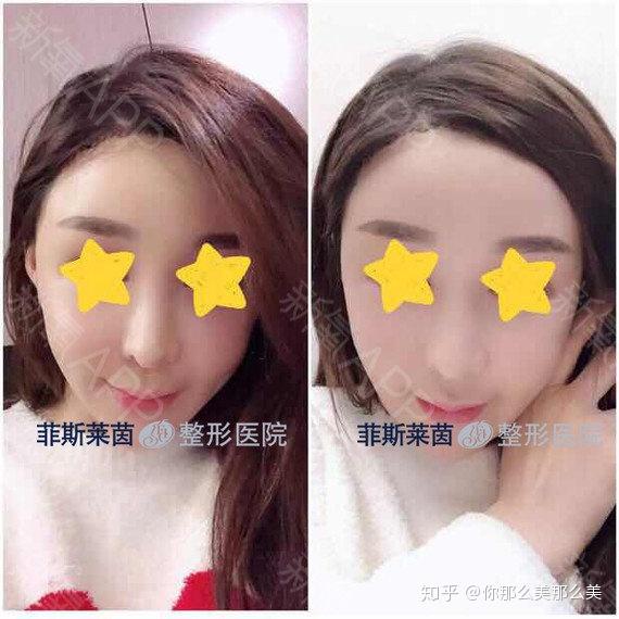 额头缩小术对比照片!