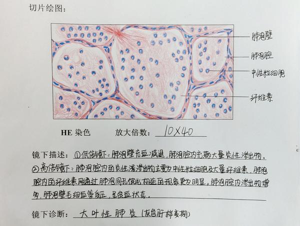 炎(灰色肝样变期) 绘图时应注意肺泡内有大量渗出物中性粒细胞和纤维