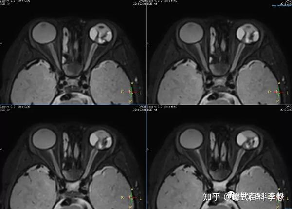 图26:3d横轴位t2脂肪抑制扫描