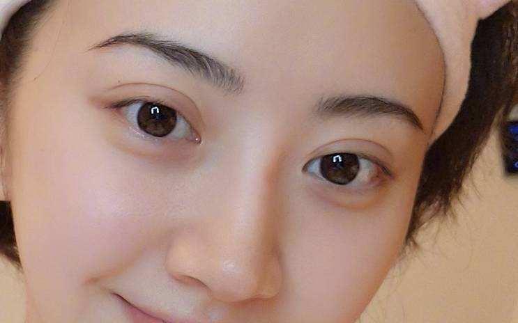 双眼皮术后产生的肉条都要修复吗?