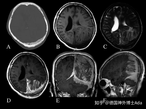 部位:90% 位于幕上,矢状窦旁>大脑凸面>嗅沟 血管周细胞瘤:流空血管影