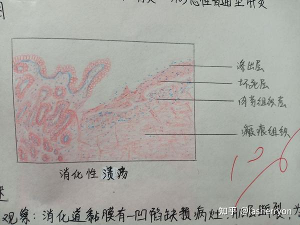 混合血栓 5.五种炎细胞 6.肺结核 7.乳腺纤维腺瘤 8.鳞状细胞癌 9.