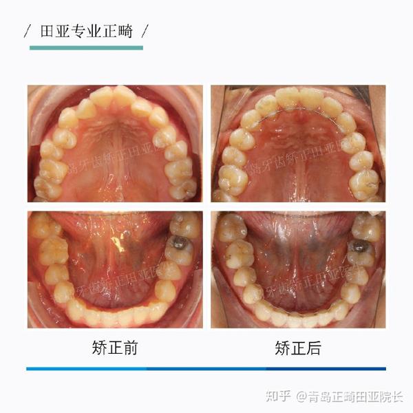 经过检查,发现患者尖牙段及前磨牙段牙弓狭窄,后牙咬合早接触,直面型