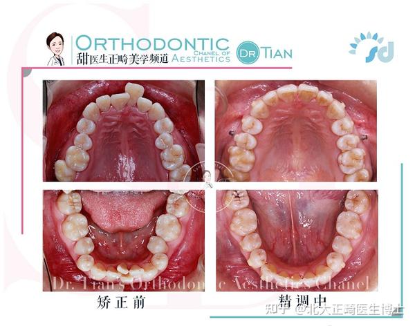 郑州牙齿矫正曹甜:矫正中嘴巴越来越凸正常吗?