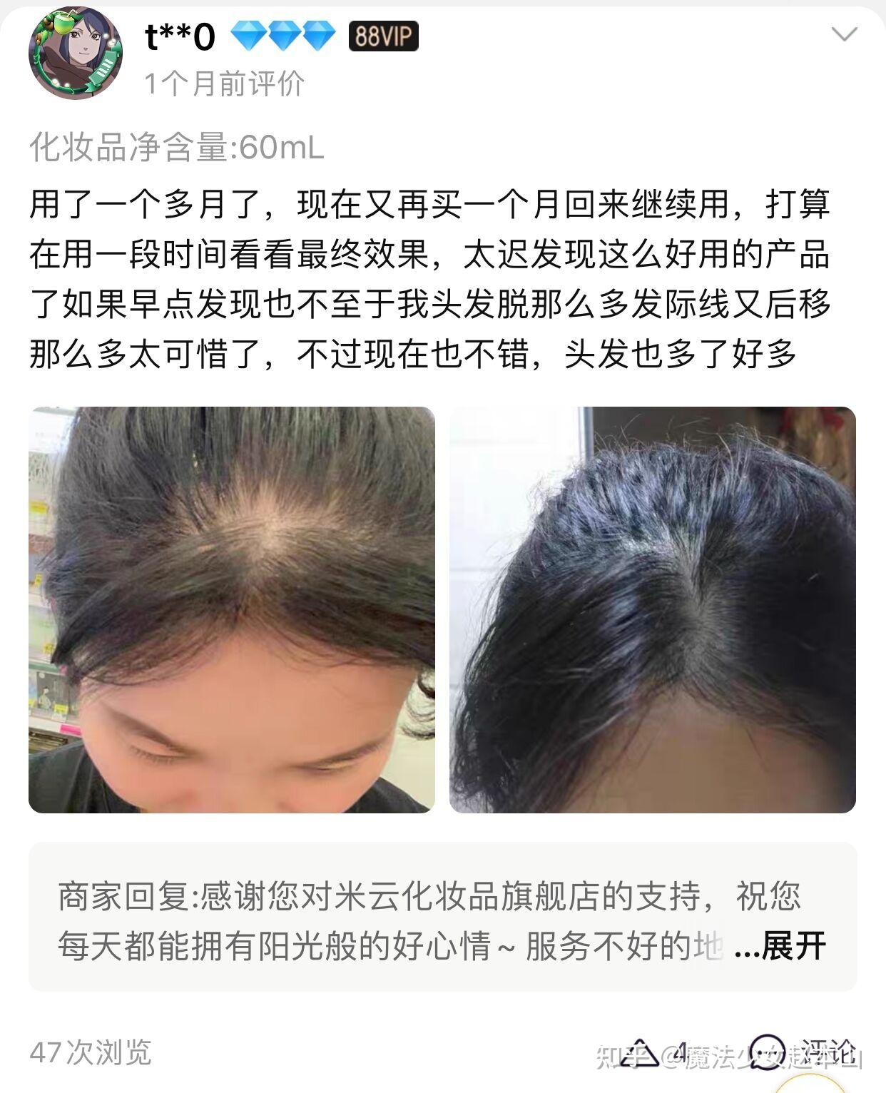 女生发量少头顶快秃了有没有什么好的生发方法跪求