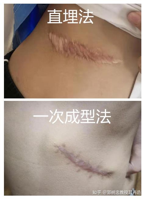 为什么要用扩张器来造耳朵?