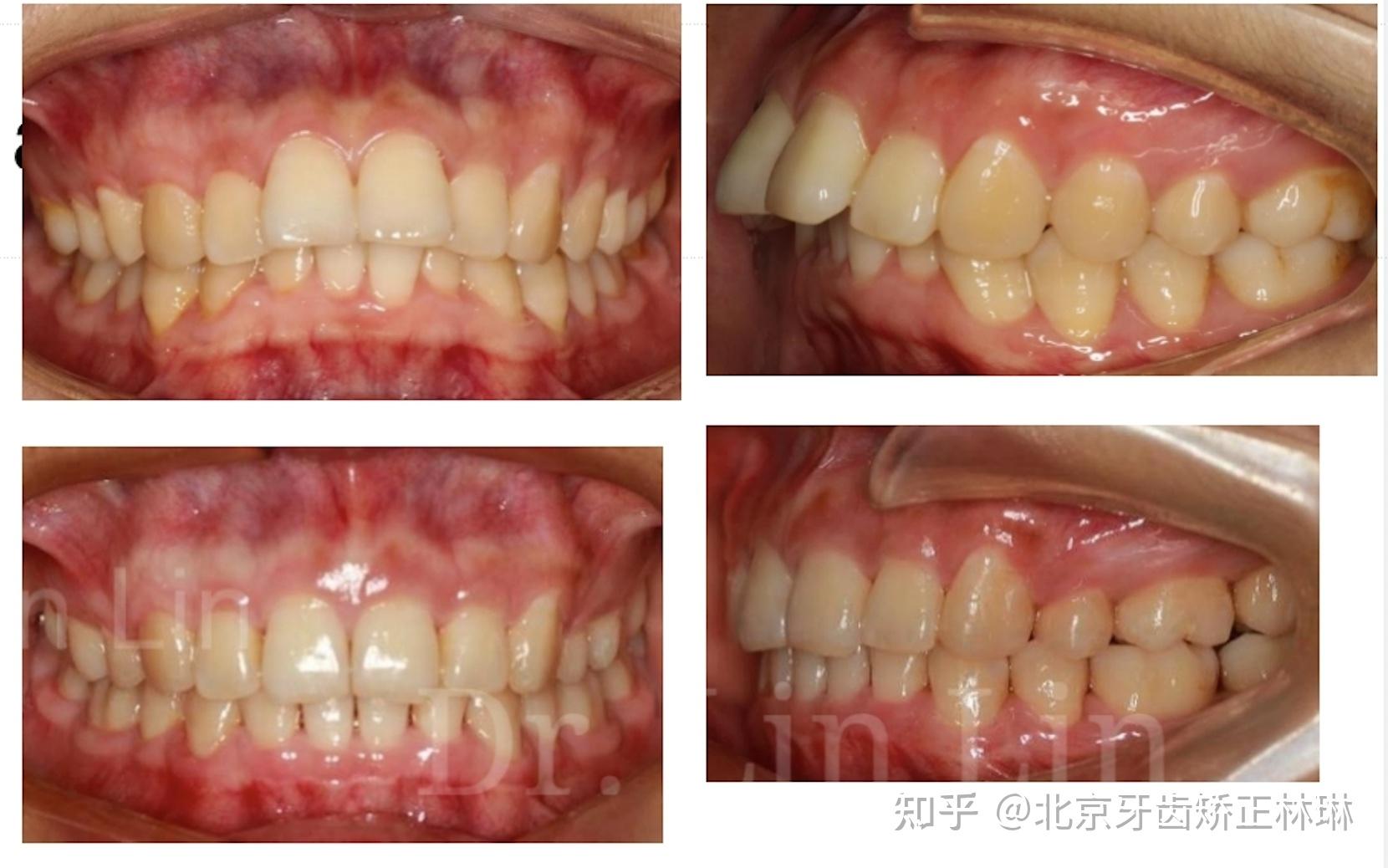 北京牙齿矫正林琳案例分享深覆合深覆盖牙齿前突牙齿拥挤