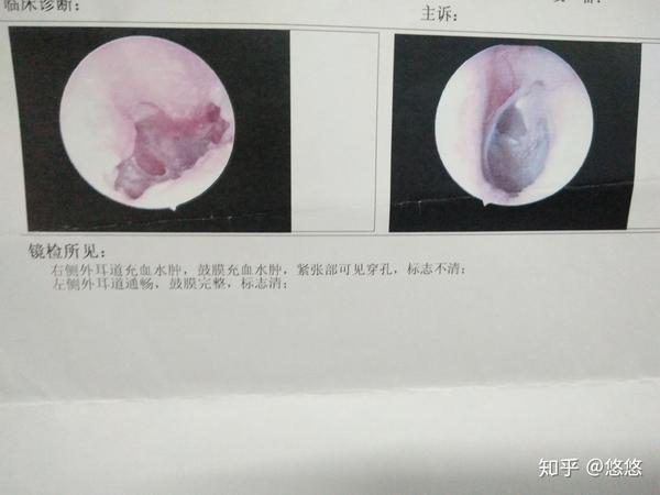 慢性化脓性中耳炎鼓膜大穿孔一年自愈经历