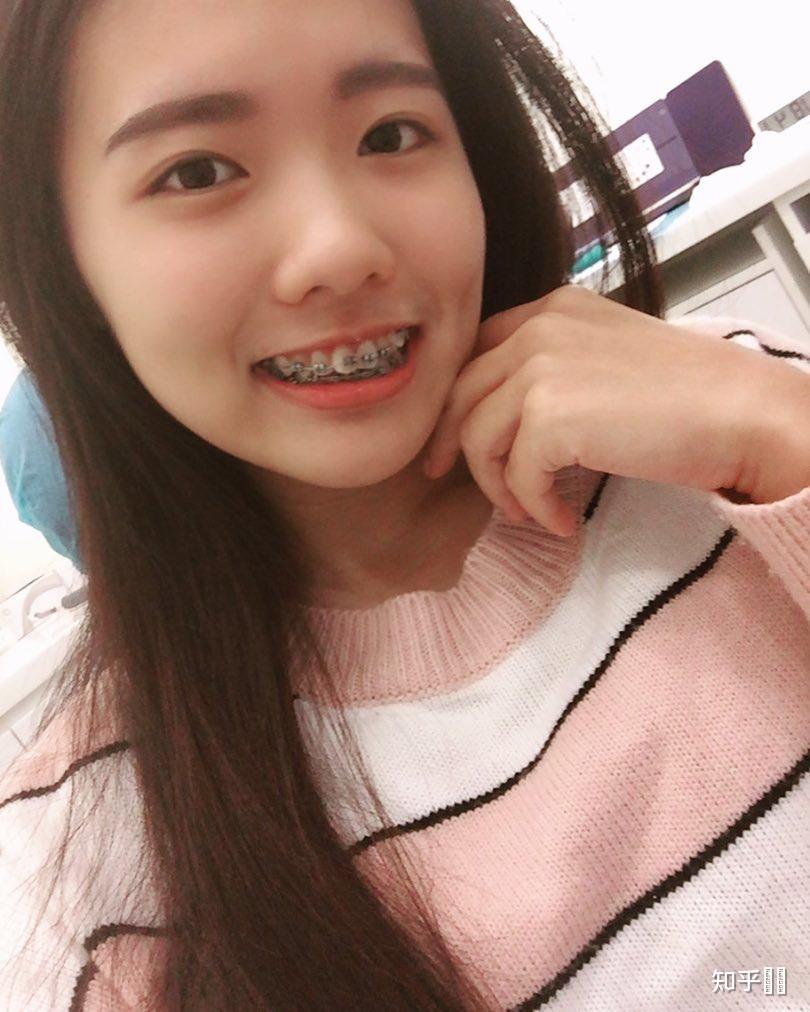 戴牙套会不会后悔