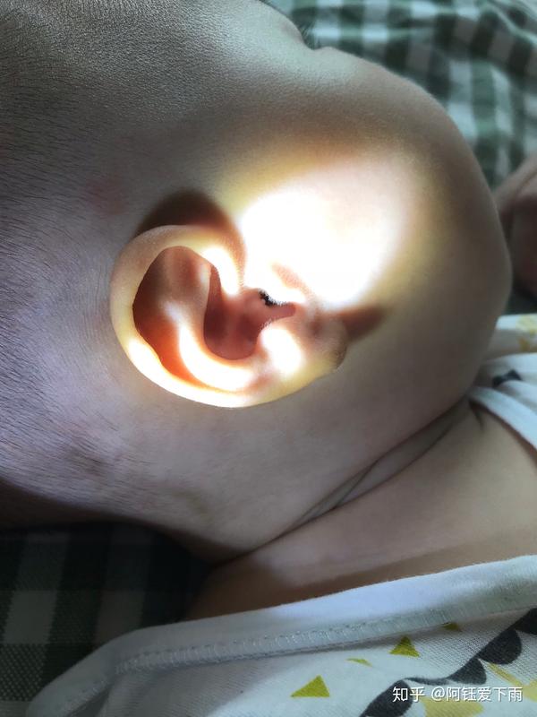 宝宝耳朵洞口长了一个白色小疙瘩,有知道怎么回事的吗