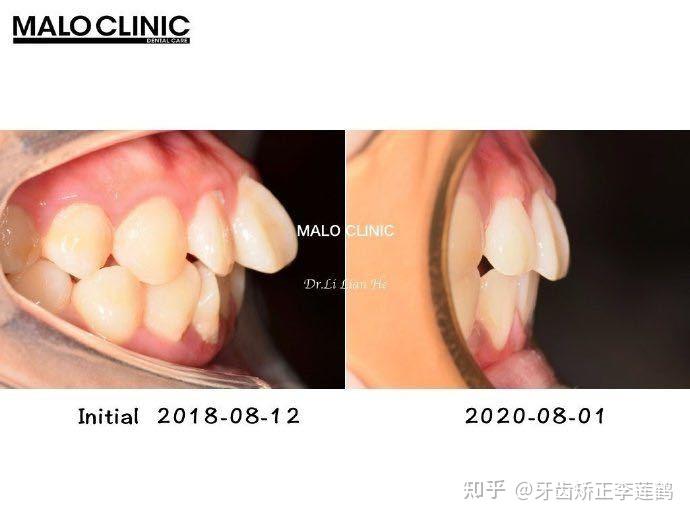北京牙齿矫正丨骨壁薄患者易发生骨开窗做好规避风险的每一步