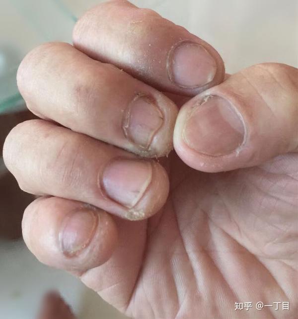 治疗灰指甲用什么最好?