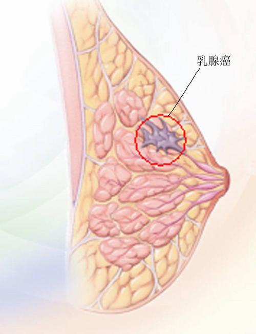 什么是小叶增生这样做有效预防小叶增生