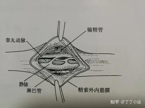 抬高并挤压阴囊1～2 分钟, 使曲张静脉内血液回流, 放大镜下游离精索