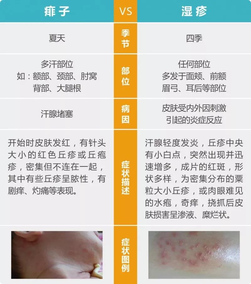 痱子湿疹幼儿急疹5种疹子分不清的家长看过来