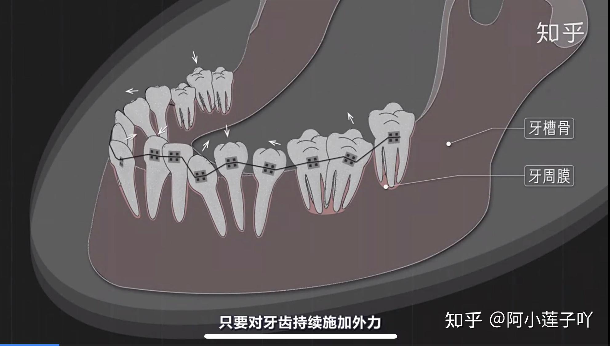 牙齿持续施加外力,就能使牙周纤维细胞产生形变,释放细胞因子,分化出