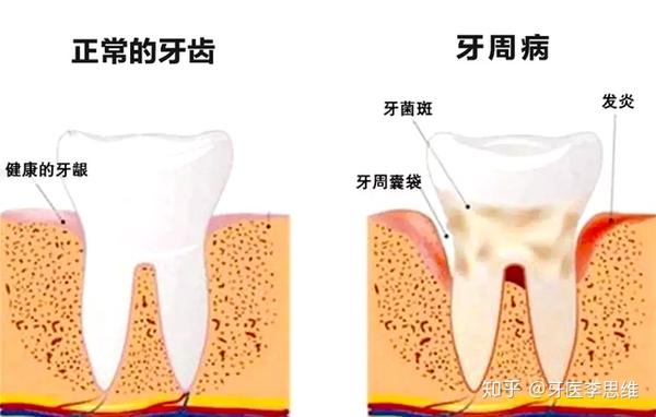 什么是牙周病?