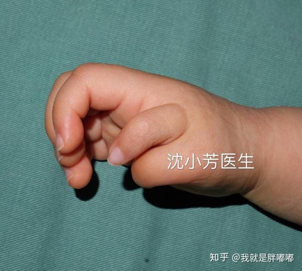 小孩子多指是什么体验?